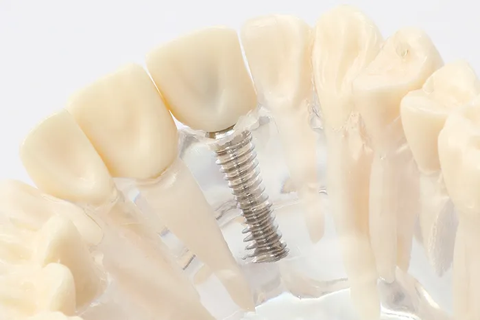 インプラント治療